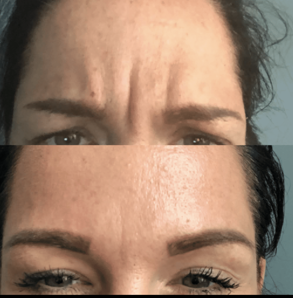 botox fronsrimpel Groningen Friesland Drenthe Overijssel Amersfoort 