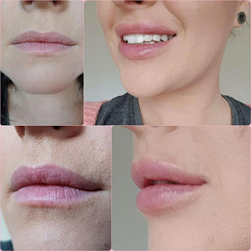 Een tijdelijk, maar veilig en langdurig resultaat met lip fillers