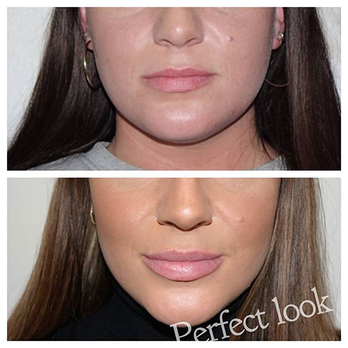 Mooie volle lippen door een lip filler behandeling bij Perfect Look