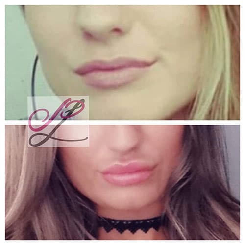 Lip fillers bij perfect look altijd scherp geprijsd 