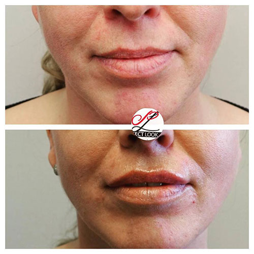 Lip fillers voor en na de behandeling