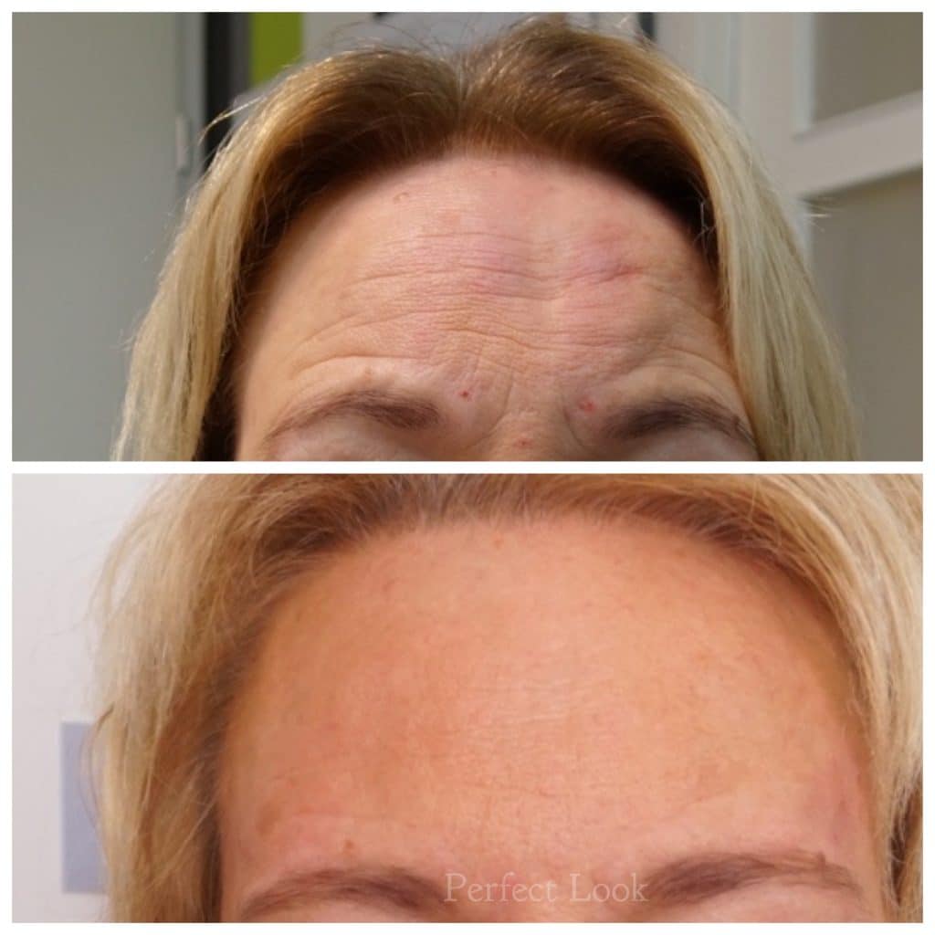 Botox behandeling van het voorhoofd. Dit geeft een frisse, minder vermoeide indruk. 