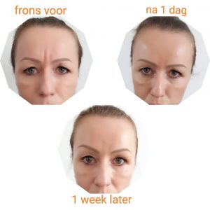 Voorbeeld botox behandeling van de Frons in Groningen