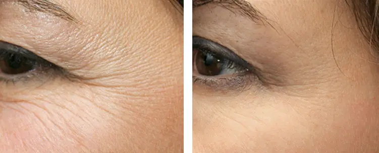 Behandeling van kraaienpootjes met botox