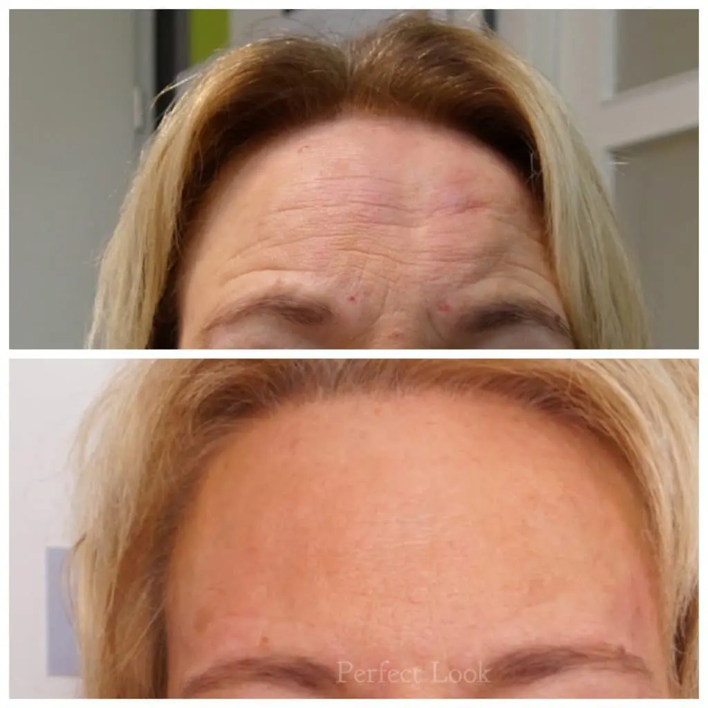 Botox voorhoofd behandeling