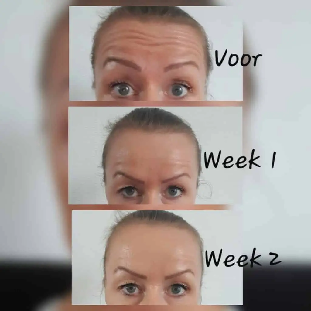 Botox voorhoofd voor en na