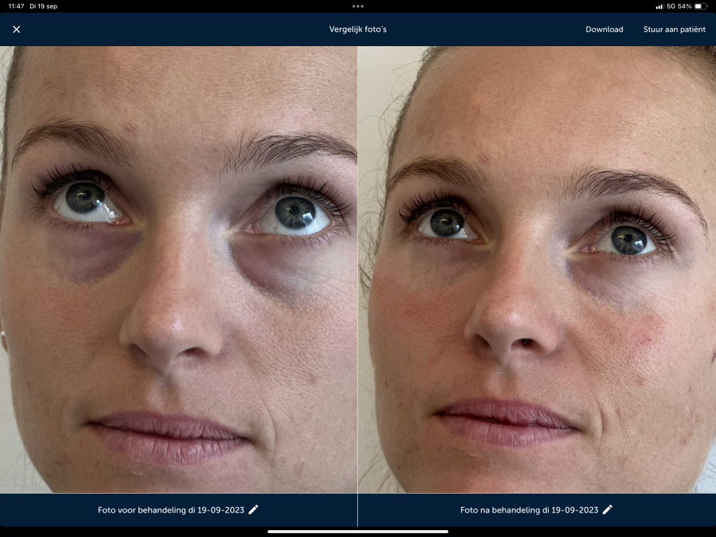 Traangoot behandeling met fillers bij Perfect Look Clinics