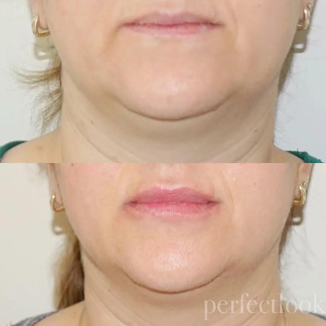 Liplijntjes opvullen met fillers