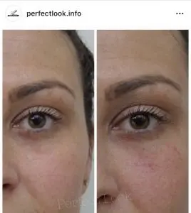 Wallen verwijderen met fillers