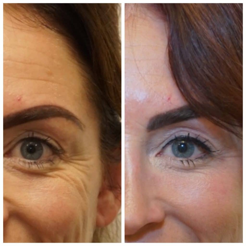 kraaienpootjes behandelen met botox