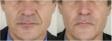 behandeling neuslippenplooi met fillers