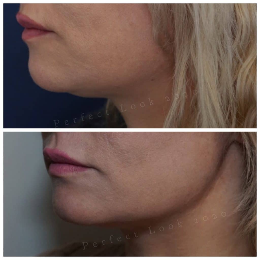 kaaklijn verstrakken met HIFU