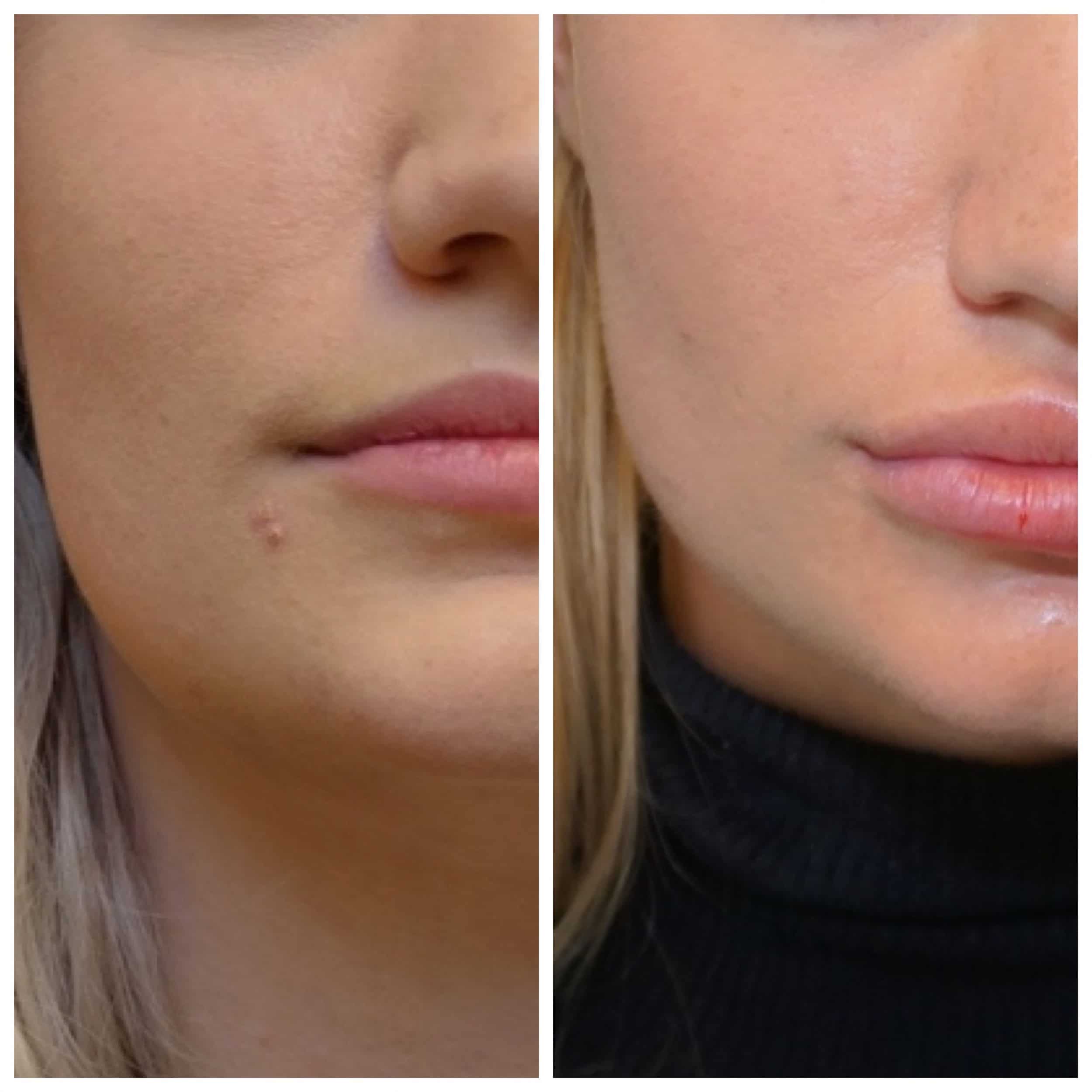 kaaklijn verstrakken met fillers