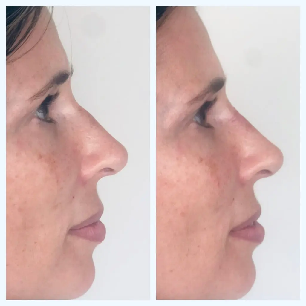 neuscorrectie zonder operatie