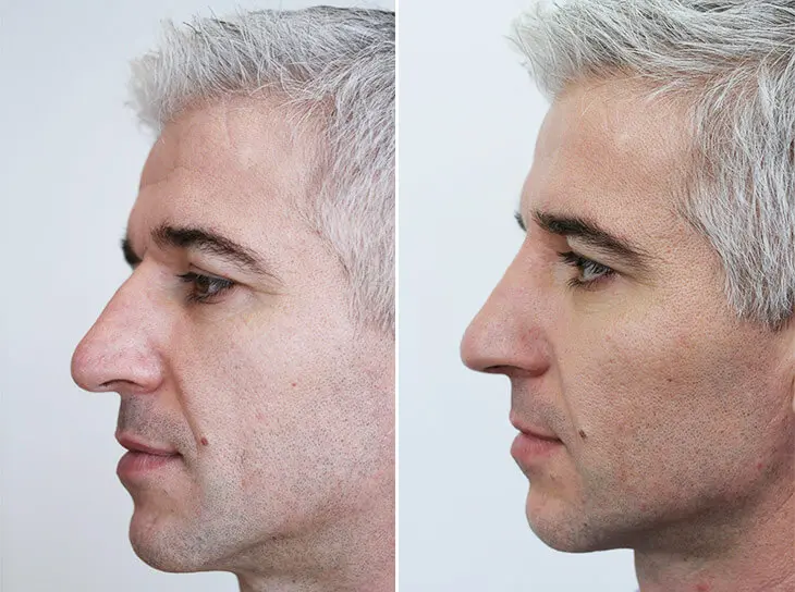 neuscorrectie met filler