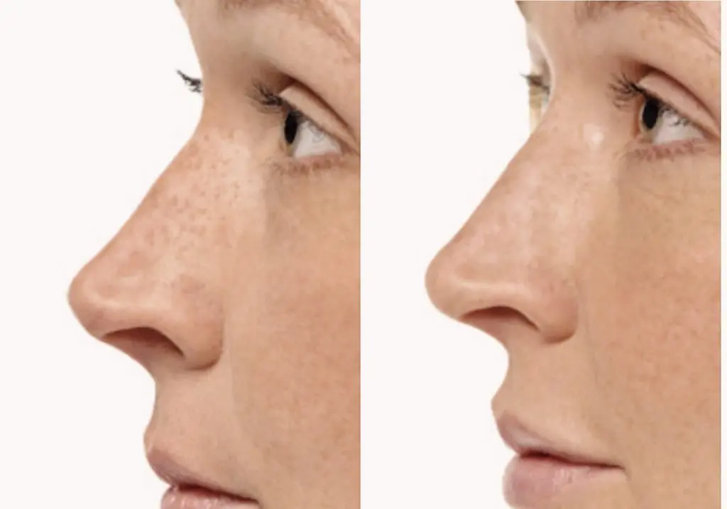 neusfillers voor correctie