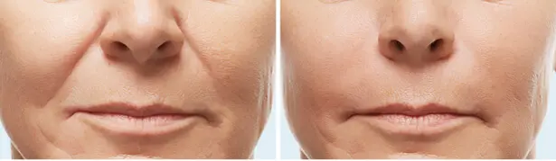 neuslippenplooi met fillers behandeling