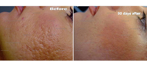 plexr behandeling voor en na