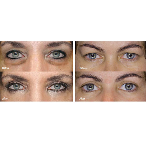 Voor en na met een Plexr behandeling