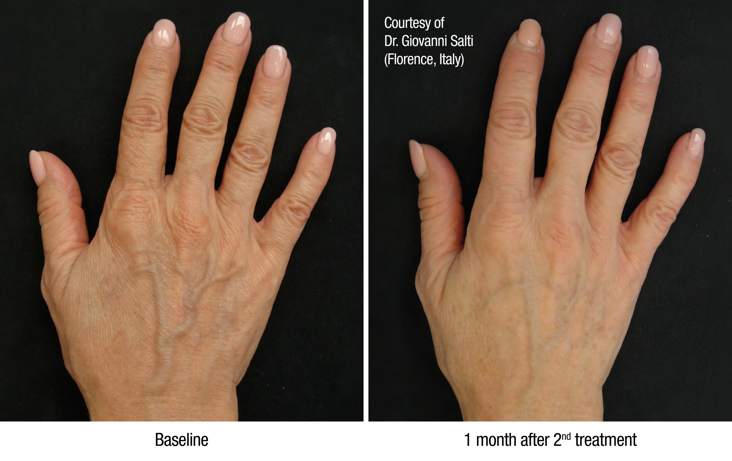 huidverstrakking handen met profhilo behandeling