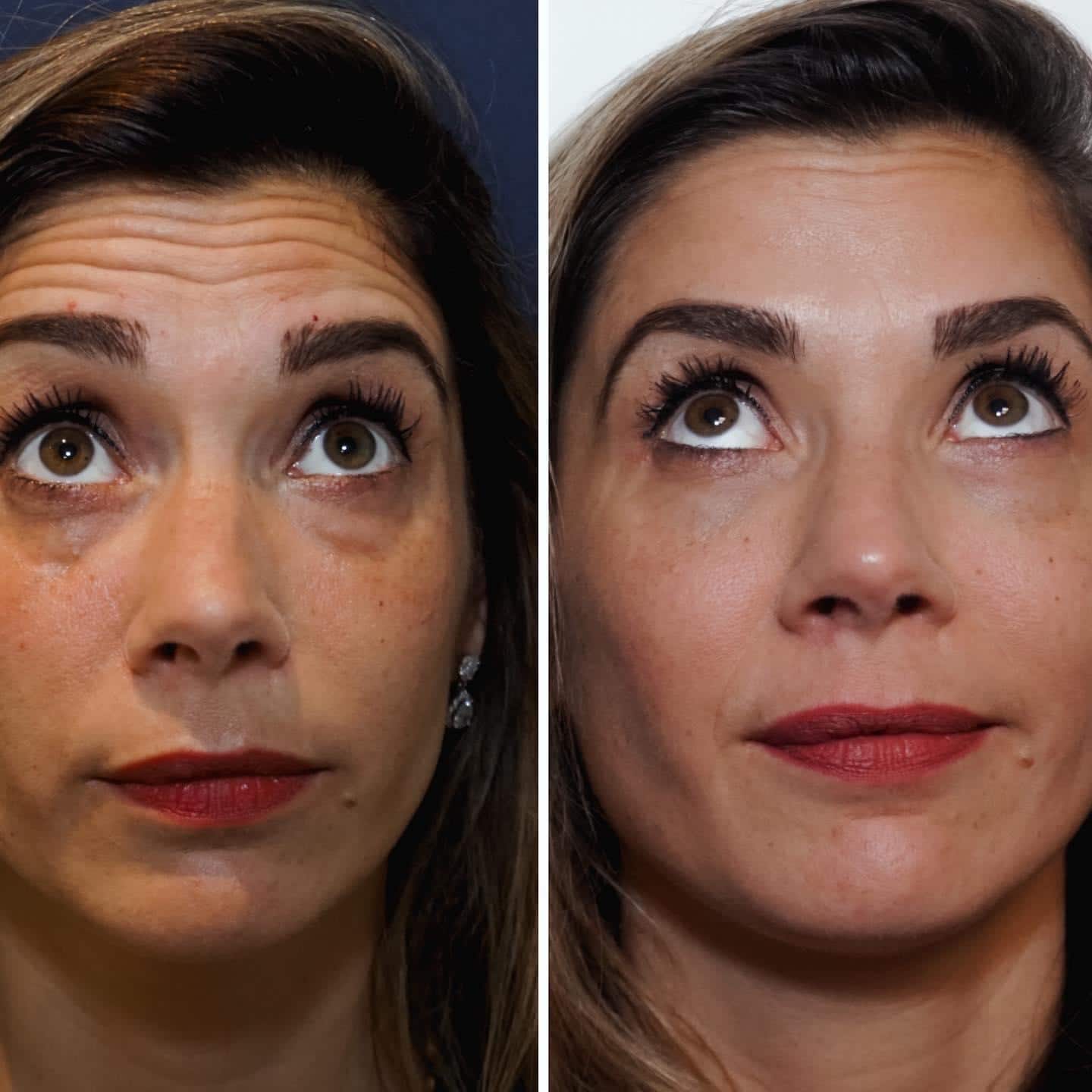 traangoot behandeling