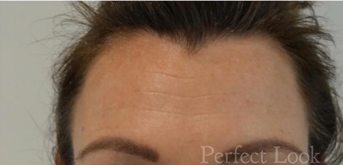 botox in het voorhoofd - na