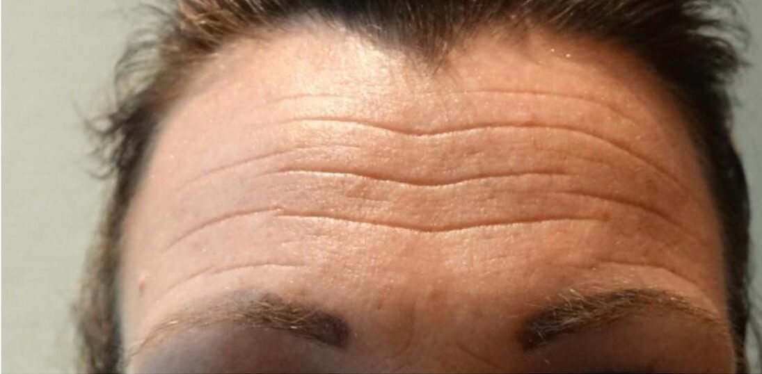 botox in het voorhoofd - voor