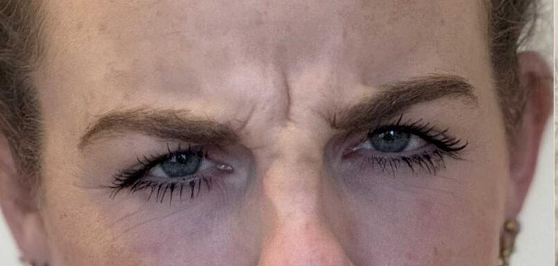 botoxbehandeling fronsrimpels - voor